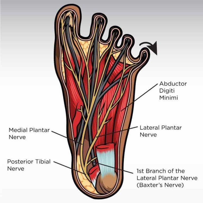 Neuropatía de Baxter