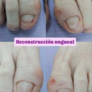 Onicoplastia o Reconstrucción de uña con composite